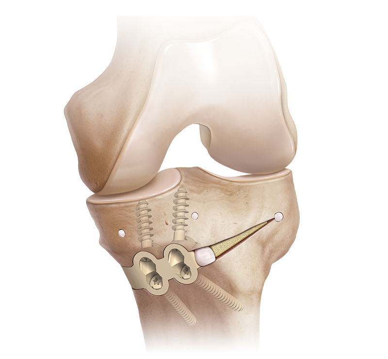 Arthrex - Proximal Tibial Osteotomy